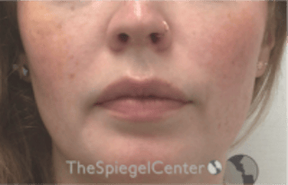 Nasolabial Fold Filler Before & After Gallery - Patient 846726 - Image 2