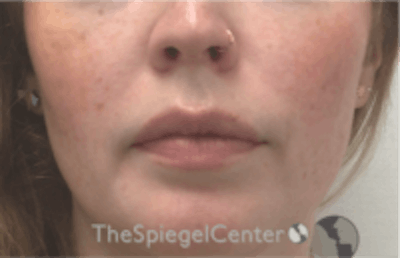 Nasolabial Fold Filler Before & After Gallery - Patient 846726 - Image 2