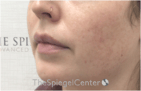 Nasolabial Fold Filler Before & After Gallery - Patient 846726 - Image 3