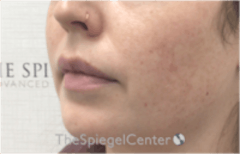 Nasolabial Fold Filler Before & After Gallery - Patient 846726 - Image 3