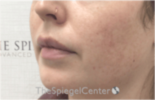 Nasolabial Fold Filler Before & After Gallery - Patient 846726 - Image 3