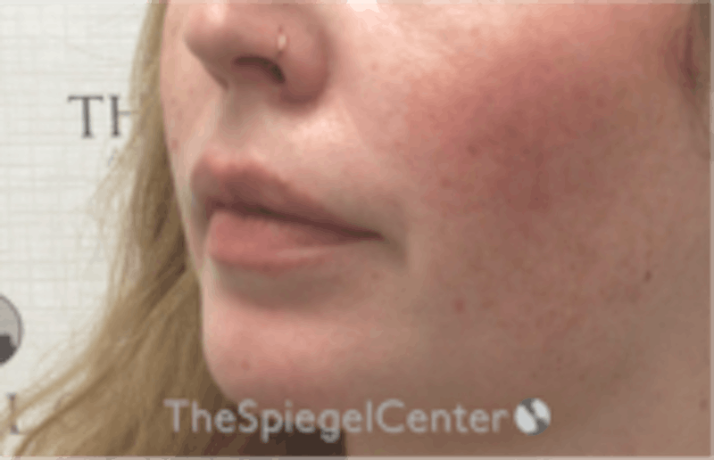 Nasolabial Fold Filler Before & After Gallery - Patient 846726 - Image 4