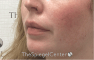 Nasolabial Fold Filler Before & After Gallery - Patient 846726 - Image 4