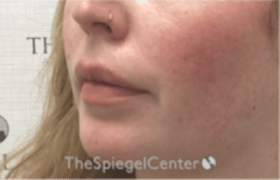 Nasolabial Fold Filler Before & After Gallery - Patient 846726 - Image 4