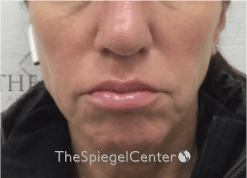 Nasolabial Fold Filler Before & After Gallery - Patient 398185 - Image 1