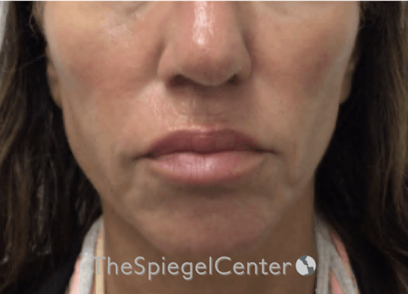 Nasolabial Fold Filler Before & After Gallery - Patient 398185 - Image 2