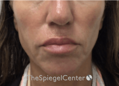 Nasolabial Fold Filler Before & After Gallery - Patient 398185 - Image 2