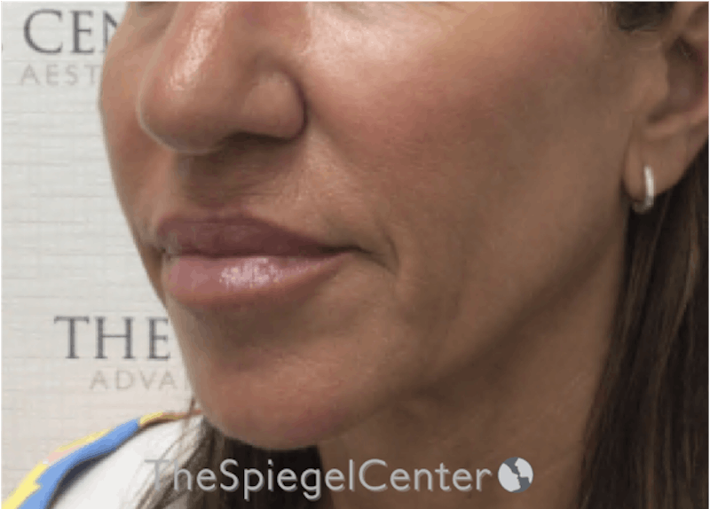 Nasolabial Fold Filler Before & After Gallery - Patient 398185 - Image 3