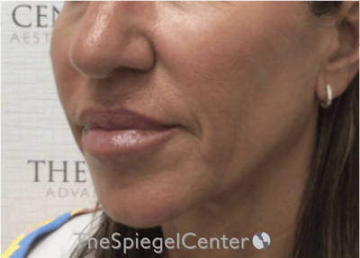 Nasolabial Fold Filler Before & After Gallery - Patient 398185 - Image 3