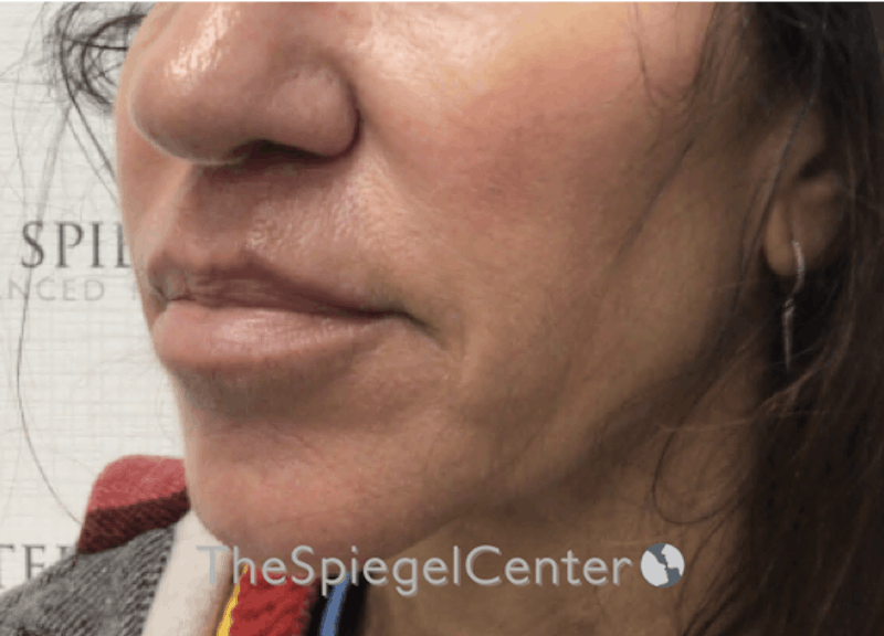 Nasolabial Fold Filler Before & After Gallery - Patient 398185 - Image 4
