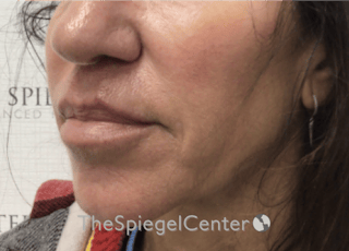 Nasolabial Fold Filler Before & After Gallery - Patient 398185 - Image 4