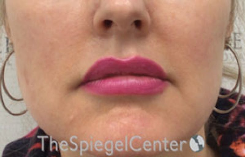 Nasolabial Fold Filler Before & After Gallery - Patient 950068 - Image 1