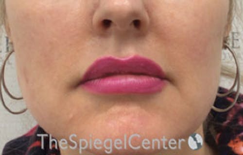 Nasolabial Fold Filler Before & After Gallery - Patient 950068 - Image 1