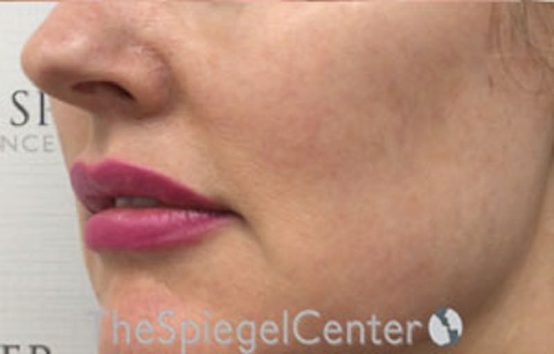Nasolabial Fold Filler Before & After Gallery - Patient 950068 - Image 3