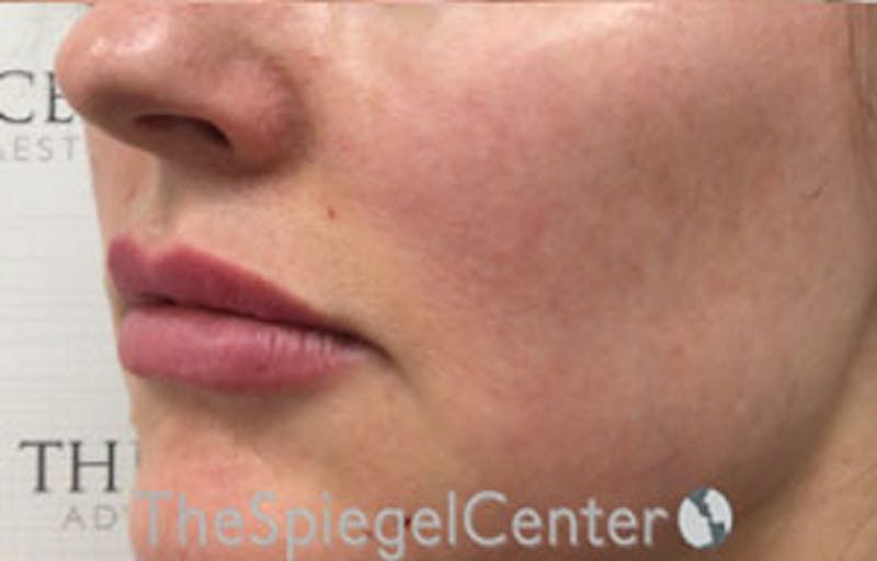 Nasolabial Fold Filler Before & After Gallery - Patient 950068 - Image 4