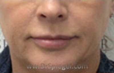 Nasolabial Fold Filler Before & After Gallery - Patient 266416 - Image 2