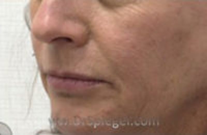 Nasolabial Fold Filler Before & After Gallery - Patient 266416 - Image 3