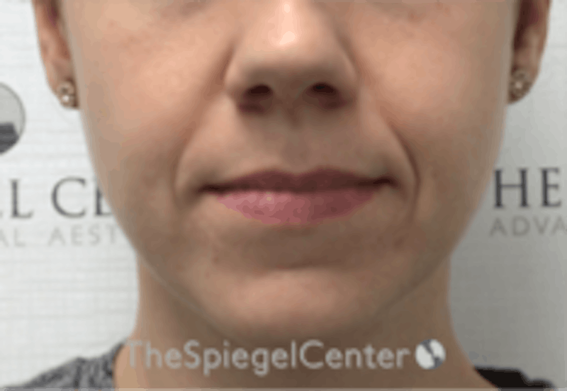 Nasolabial Fold Filler Before & After Gallery - Patient 334222 - Image 1