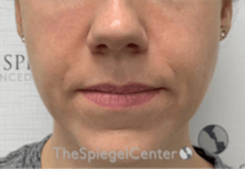 Nasolabial Fold Filler Before & After Gallery - Patient 334222 - Image 2