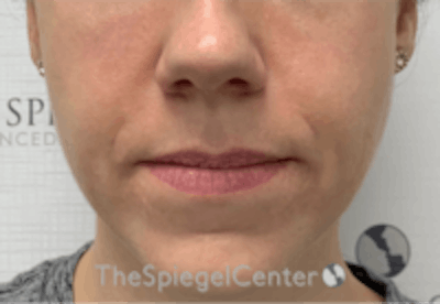 Nasolabial Fold Filler Before & After Gallery - Patient 334222 - Image 2