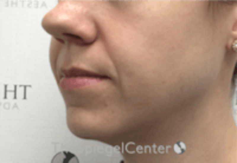 Nasolabial Fold Filler Before & After Gallery - Patient 334222 - Image 3