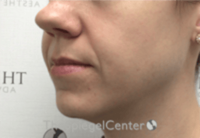 Nasolabial Fold Filler Before & After Gallery - Patient 334222 - Image 3