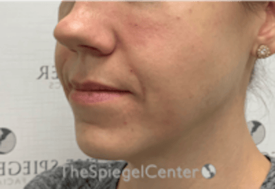 Nasolabial Fold Filler Before & After Gallery - Patient 334222 - Image 4