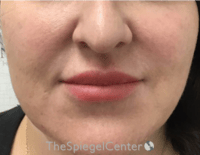 Nasolabial Fold Filler Before & After Gallery - Patient 198310 - Image 1