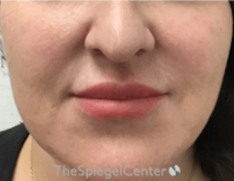 Nasolabial Fold Filler Before & After Gallery - Patient 198310 - Image 1