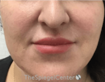 Nasolabial Fold Filler Before & After Gallery - Patient 198310 - Image 1