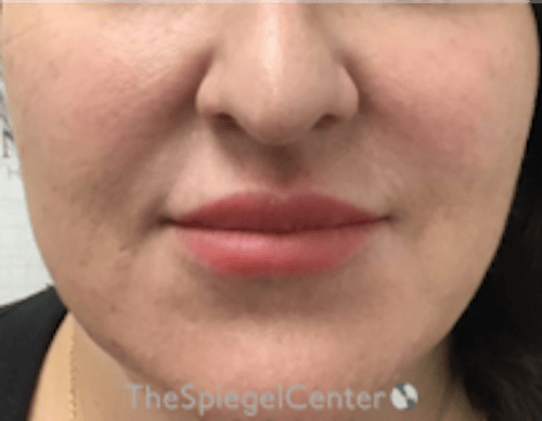 Nasolabial Fold Filler Before & After Gallery - Patient 198310 - Image 1