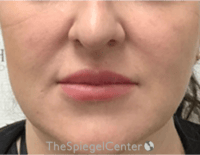 Nasolabial Fold Filler Before & After Gallery - Patient 198310 - Image 2