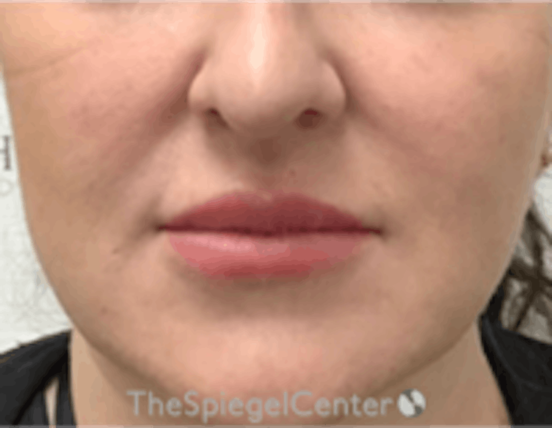 Nasolabial Fold Filler Before & After Gallery - Patient 198310 - Image 2