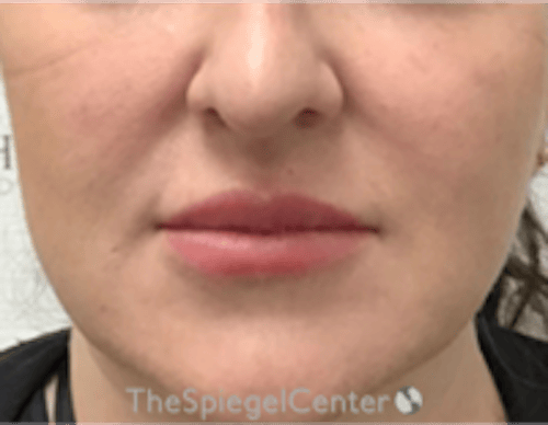 Nasolabial Fold Filler Before & After Gallery - Patient 198310 - Image 2