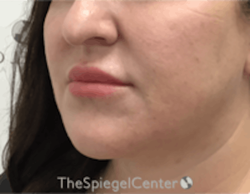 Nasolabial Fold Filler Before & After Gallery - Patient 198310 - Image 3