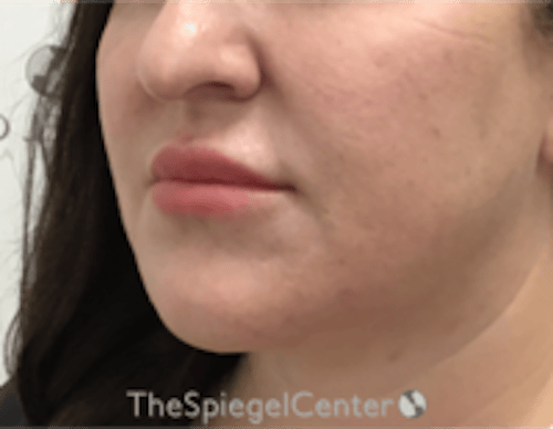 Nasolabial Fold Filler Before & After Gallery - Patient 198310 - Image 3