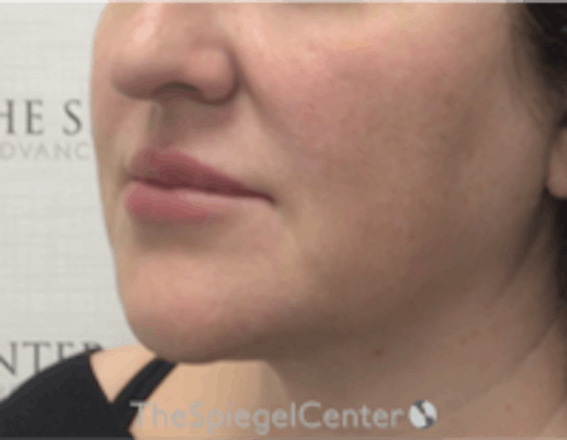 Nasolabial Fold Filler Before & After Gallery - Patient 198310 - Image 4