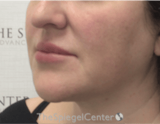 Nasolabial Fold Filler Before & After Gallery - Patient 198310 - Image 4