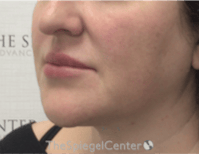 Nasolabial Fold Filler Before & After Gallery - Patient 198310 - Image 4