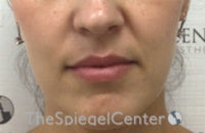 Nasolabial Fold Filler Before & After Gallery - Patient 132458 - Image 1