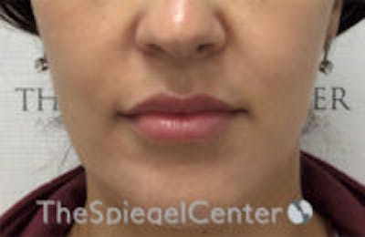 Nasolabial Fold Filler Before & After Gallery - Patient 132458 - Image 2