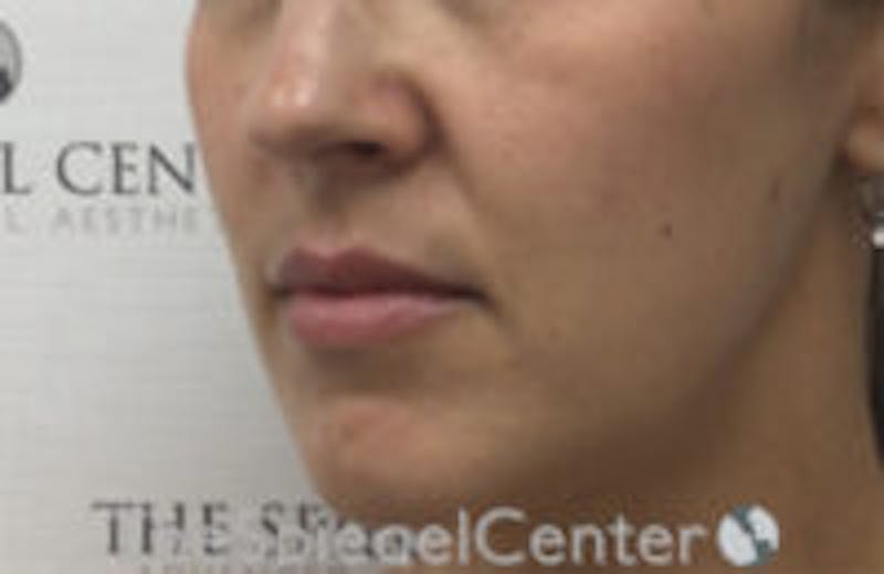 Nasolabial Fold Filler Before & After Gallery - Patient 132458 - Image 3