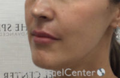 Nasolabial Fold Filler Before & After Gallery - Patient 132458 - Image 4