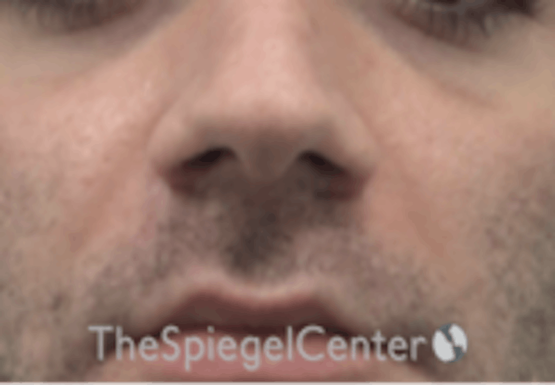 Nasolabial Fold Filler Before & After Gallery - Patient 408574 - Image 2