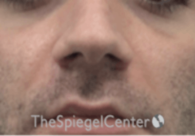 Nasolabial Fold Filler Before & After Gallery - Patient 408574 - Image 2