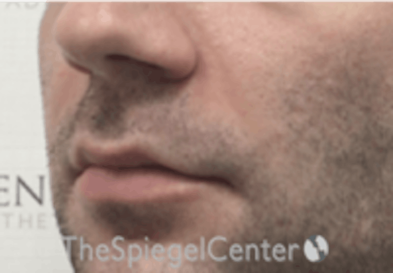 Nasolabial Fold Filler Before & After Gallery - Patient 408574 - Image 3