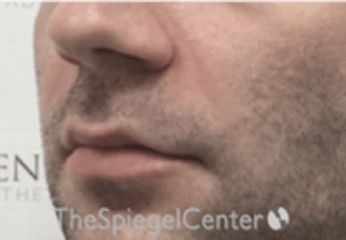 Nasolabial Fold Filler Before & After Gallery - Patient 408574 - Image 3