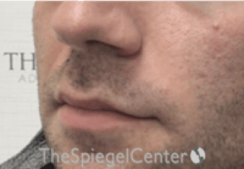 Nasolabial Fold Filler Before & After Gallery - Patient 408574 - Image 4