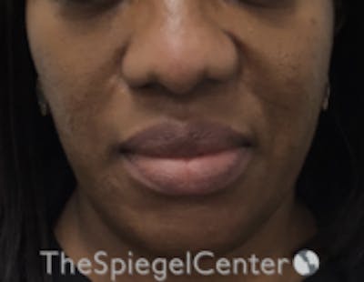 Nasolabial Fold Filler Before & After Gallery - Patient 603152 - Image 1