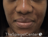 Nasolabial Fold Filler Before & After Gallery - Patient 603152 - Image 2